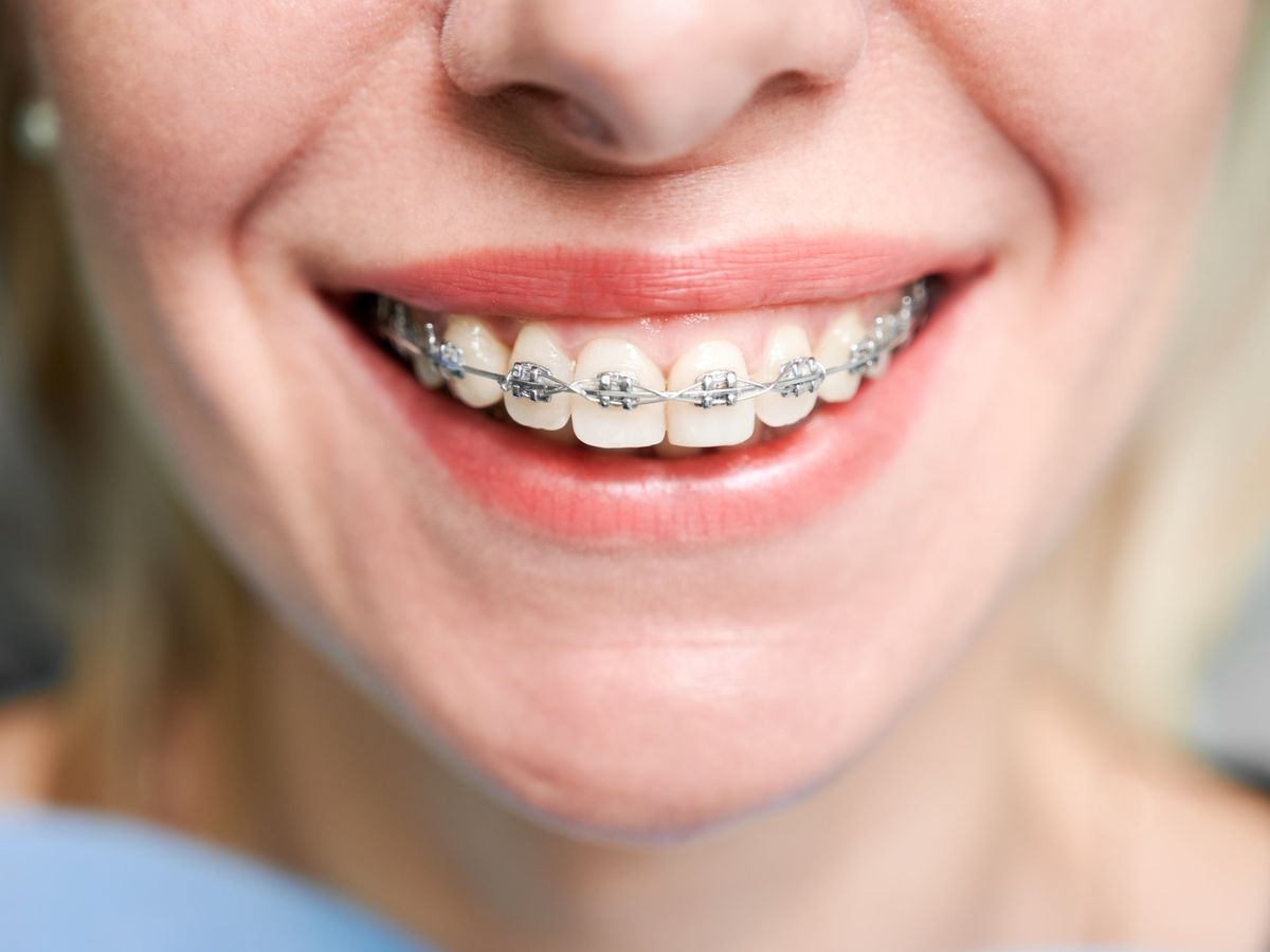 Aparelho dentário