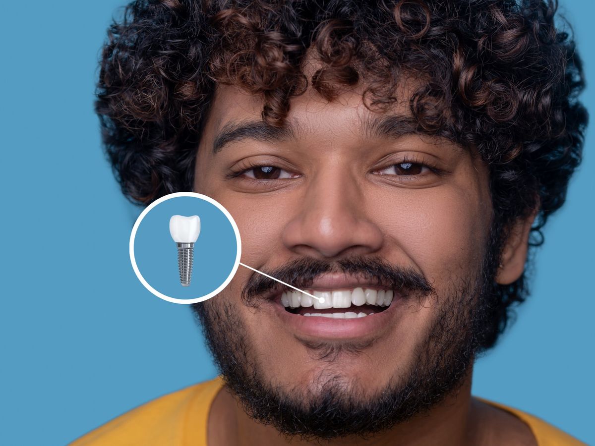 Implantes dentários