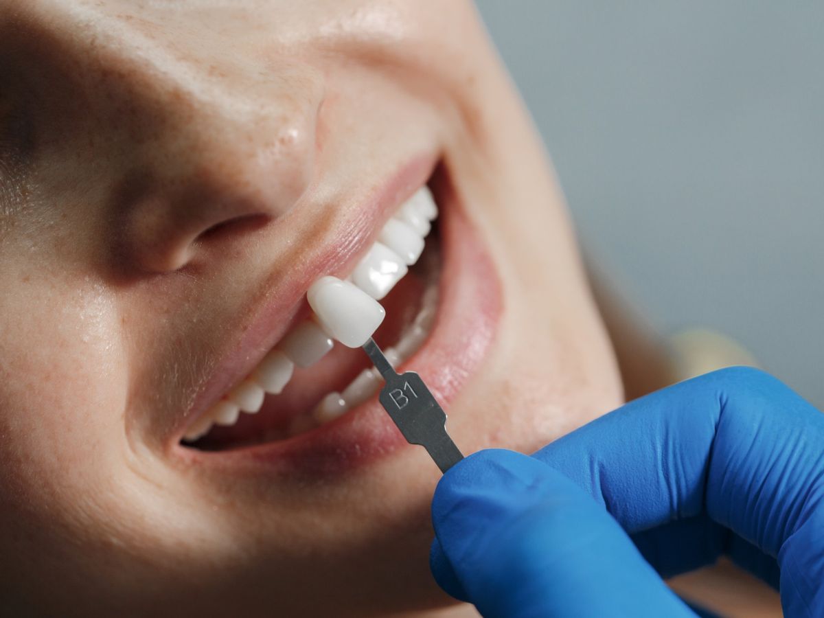 Lentes de contato dental e facetas